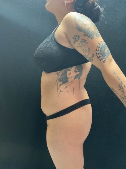 VASER Liposuction Before & After Patient #2614