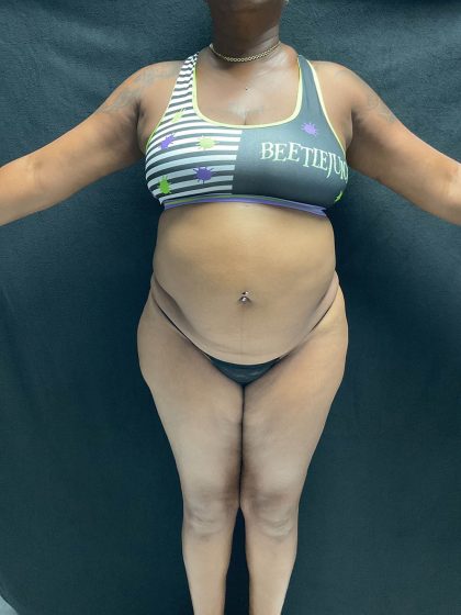 VASER Liposuction Before & After Patient #2609