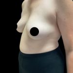 Breast Augmentation Before & After Patient #2608