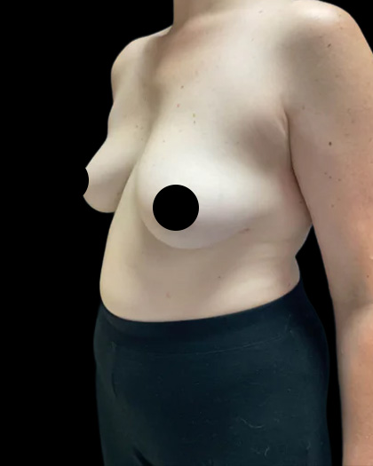 Breast Augmentation Before & After Patient #2608