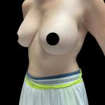 Breast Augmentation Before & After Patient #2608