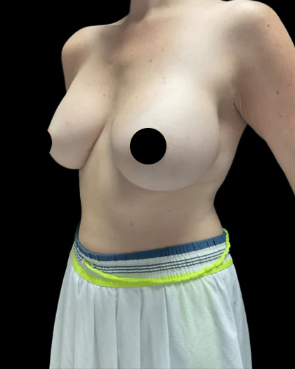 Breast Augmentation Before & After Patient #2608