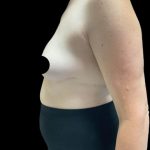 Breast Augmentation Before & After Patient #2608
