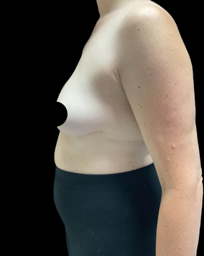 Breast Augmentation Before & After Patient #2608