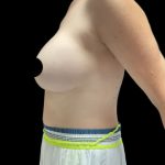 Breast Augmentation Before & After Patient #2608