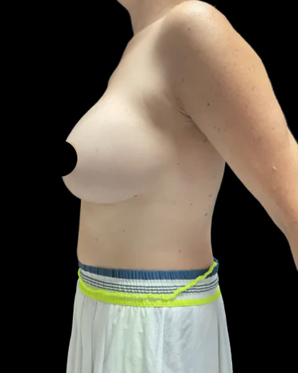 Breast Augmentation Before & After Patient #2608