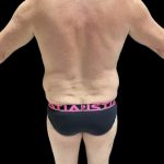 VASER Liposuction Before & After Patient #2521