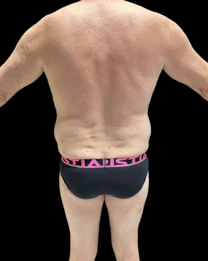 VASER Liposuction Before & After Patient #2521
