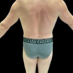 VASER Liposuction Before & After Patient #2521