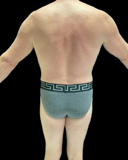 VASER Liposuction Before & After Patient #2521