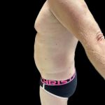 VASER Liposuction Before & After Patient #2521