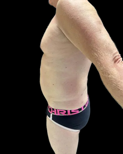 VASER Liposuction Before & After Patient #2521