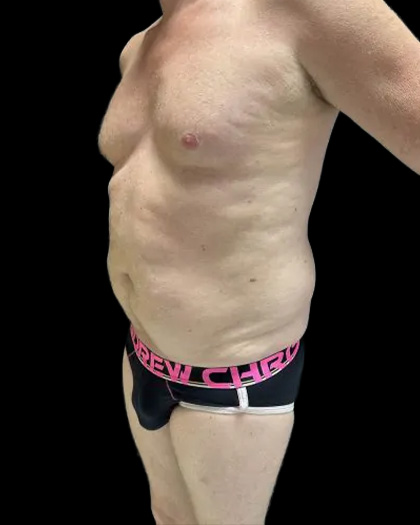 VASER Liposuction Before & After Patient #2521