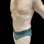 VASER Liposuction Before & After Patient #2521