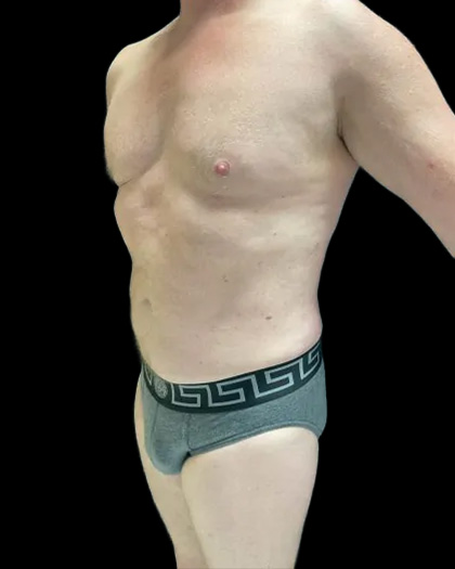 VASER Liposuction Before & After Patient #2521