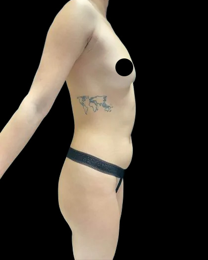 VASER Liposuction Before & After Patient #2607