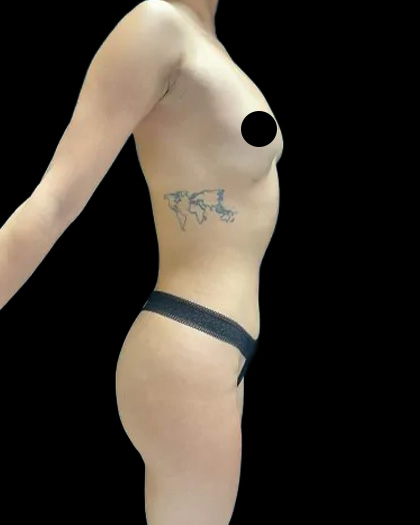 VASER Liposuction Before & After Patient #2607