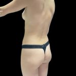 VASER Liposuction Before & After Patient #2607