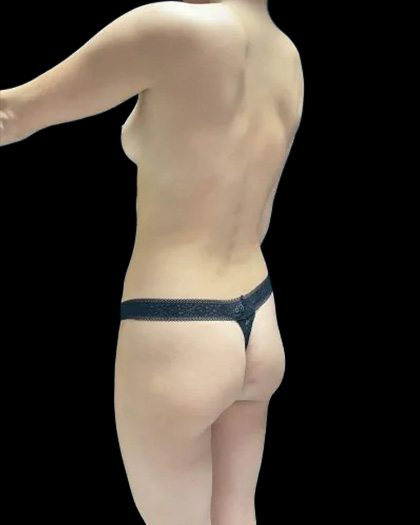 VASER Liposuction Before & After Patient #2607