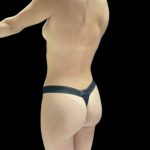 VASER Liposuction Before & After Patient #2607
