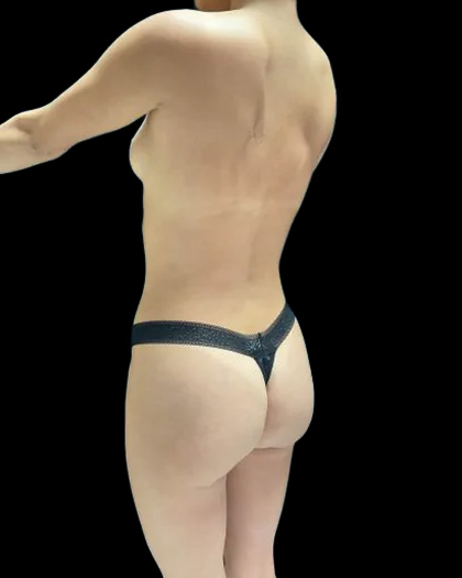 VASER Liposuction Before & After Patient #2607