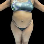 VASER Liposuction Before & After Patient #2609