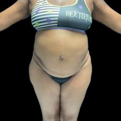 VASER Liposuction Before & After Patient #2609