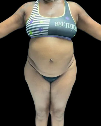 VASER Liposuction Before & After Patient #2609