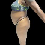 VASER Liposuction Before & After Patient #2609