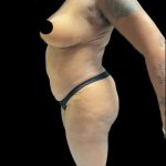 VASER Liposuction Before & After Patient #2609