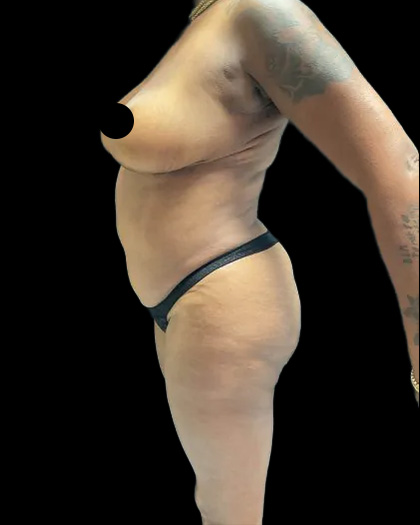 VASER Liposuction Before & After Patient #2609