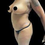 VASER Liposuction Before & After Patient #2609