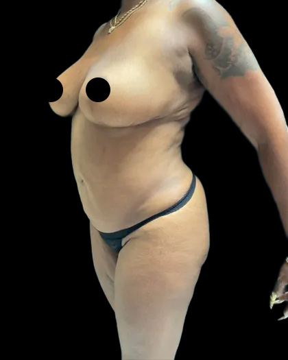 VASER Liposuction Before & After Patient #2609