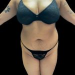 VASER Liposuction Before & After Patient #2614