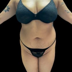 VASER Liposuction Before & After Patient #2614