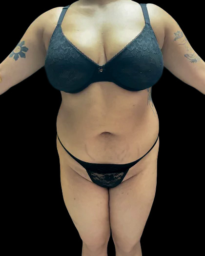 VASER Liposuction Before & After Patient #2614
