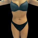 VASER Liposuction Before & After Patient #2614