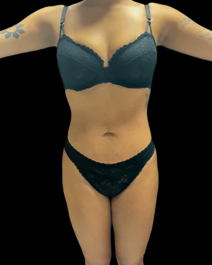 VASER Liposuction Before & After Patient #2614