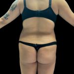 VASER Liposuction Before & After Patient #2614