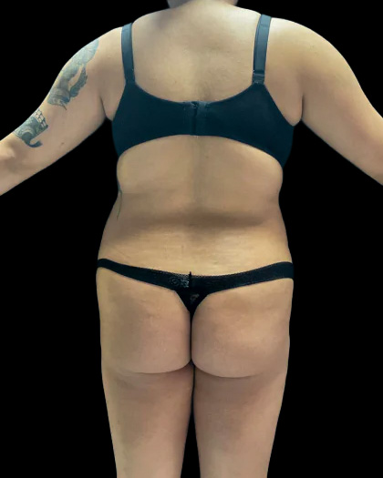 VASER Liposuction Before & After Patient #2614