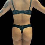 VASER Liposuction Before & After Patient #2614