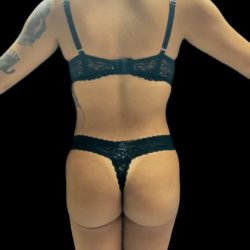 Brazilian Butt Lift Before & After Patient #2614