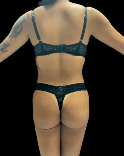 VASER Liposuction Before & After Patient #2614