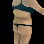 VASER Liposuction Before & After Patient #2614