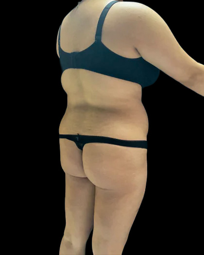 VASER Liposuction Before & After Patient #2614