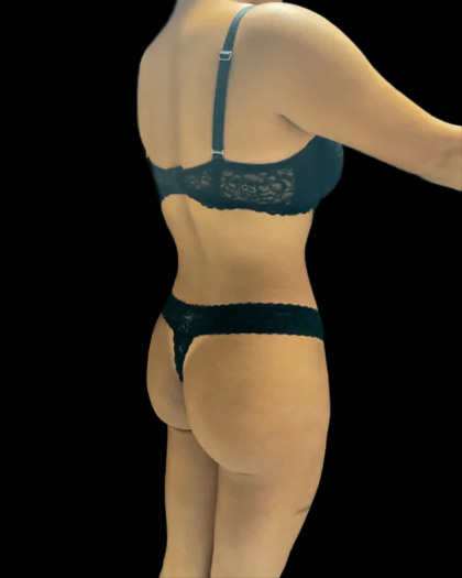 VASER Liposuction Before & After Patient #2614