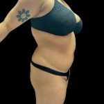 VASER Liposuction Before & After Patient #3157