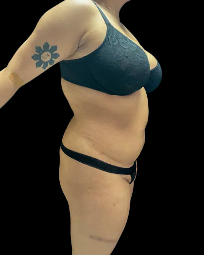 VASER Liposuction Before & After Patient #2614