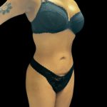 VASER Liposuction Before & After Patient #3157