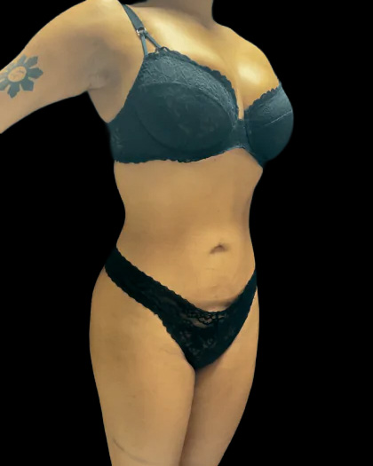 VASER Liposuction Before & After Patient #2614